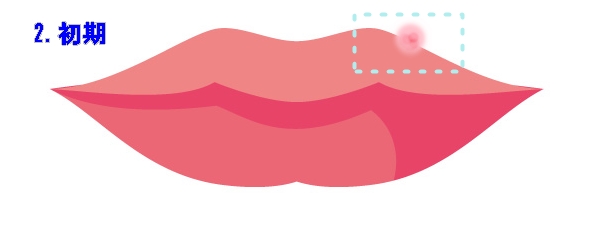 唇にできる「ぶつぶつ・ざらざら」の原因と考えられる病気 | 美肌の神様徒然（つれづれ）日記