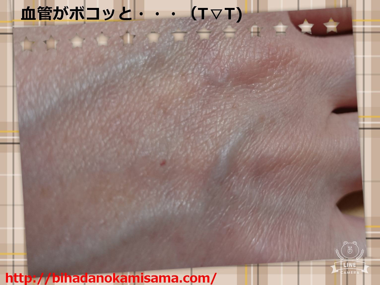 手の甲に血管が浮き出る7つの原因とは?病気の可能性もチェックしよう | 美肌の神様徒然(つれづれ)日記